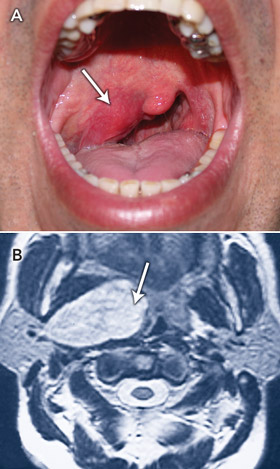 Tonsillar Neoplasms Cancer Of Tonsil Tonsillar Cancer