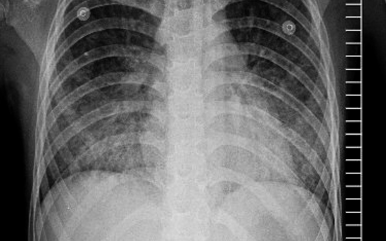 Covid 19 Ards Clinical Features And Differences To Usual Pre Covid Ards The Medical Journal Of Australia