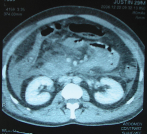 renal halo sign in acute pancreatitis