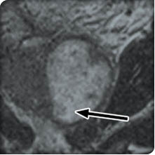 Multifocal abscesses due to multiresistant Escherichia coli after ...