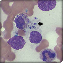 Visceral leishmaniasis in a patient taking adalimumab for rheumatoid ...