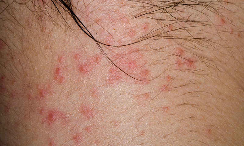 Treatment failure in atopic dermatitis as a result of parental health