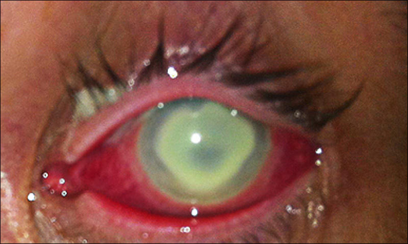 Severe Bilateral Pseudomonas Keratitis Exacerbated By Prolonged Contact Lens Wear The Medical Journal Of Australia