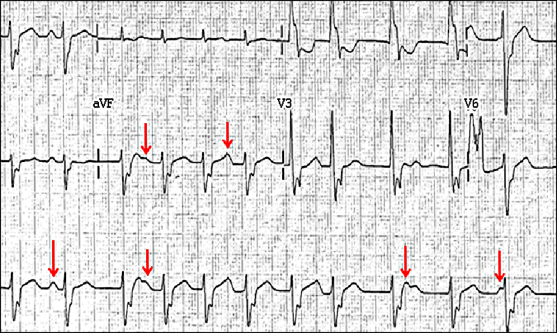 Irregular Rhythm