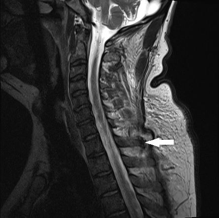 Spinal gout mimicking osteomyelitis | The Medical Journal of Australia