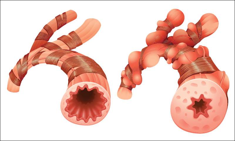 The Effect of Stress on Cardiovascular Disorders