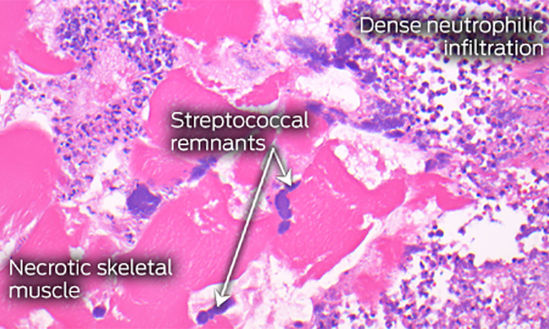 Necrotising myositis presenting as multiple limb myalgia | The Medical ...