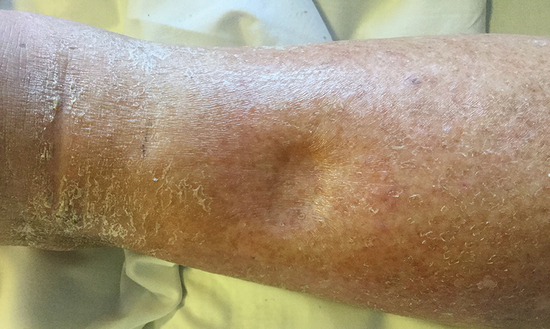 Pitting and non-pitting oedema | The Medical Journal of Australia