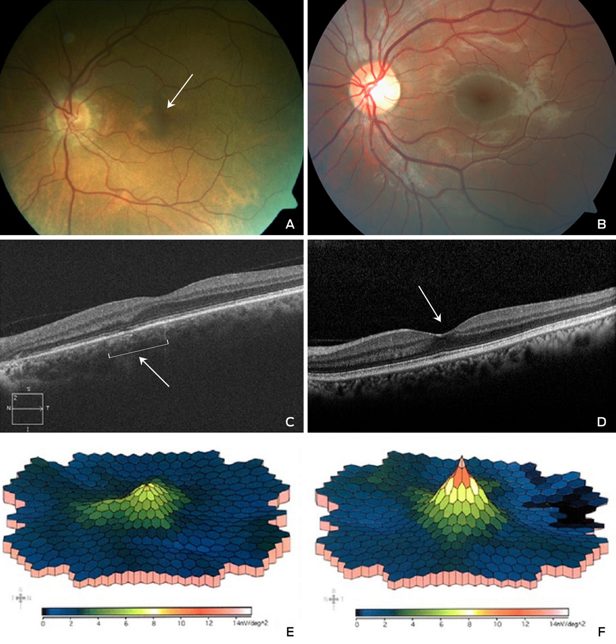 Retinal vascular assessment in psoriatic patients with and without  metabolic syndrome using optical coherence tomography angiography