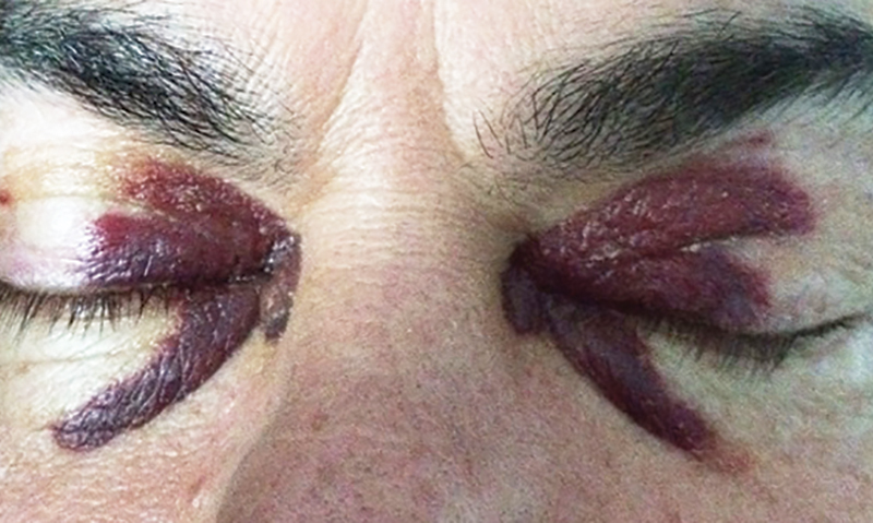 Raccoon eyes in systemic light chain amyloidosis | The Medical Journal