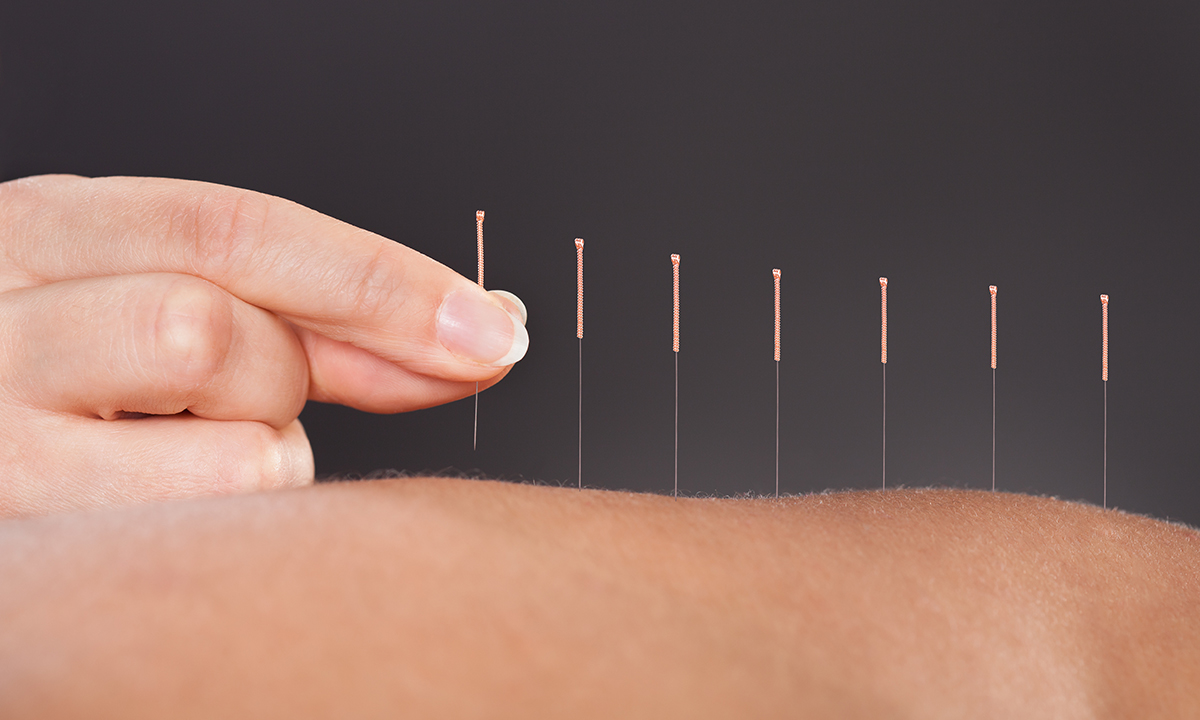 Acupuncture For Analgesia In The Emergency Department A - 