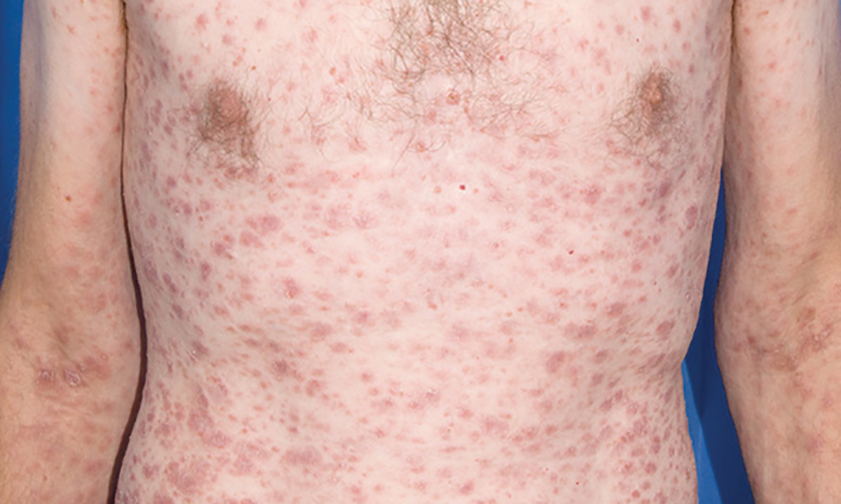 A rash diagnosis The Medical Journal of Australia