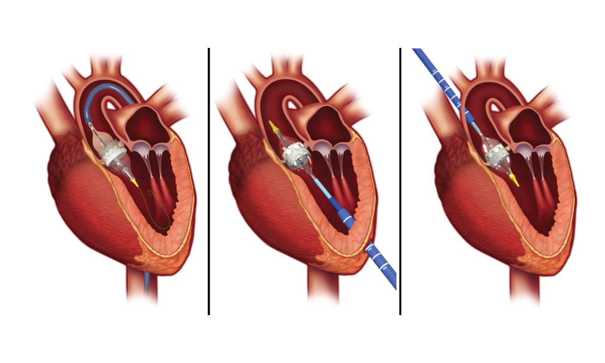 transcatheter-aortic-valve-implantation-a-new-standard-of-care-the