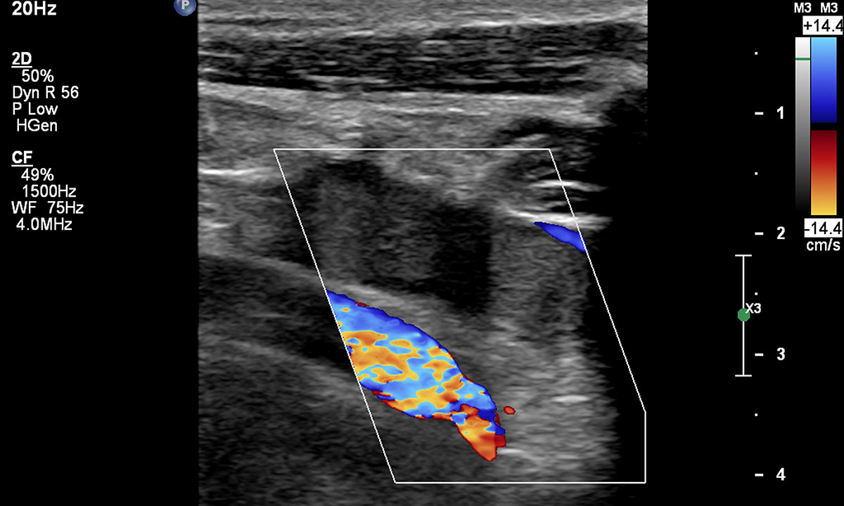 Subclavian vein thrombosis with internal jugular vein extension in an