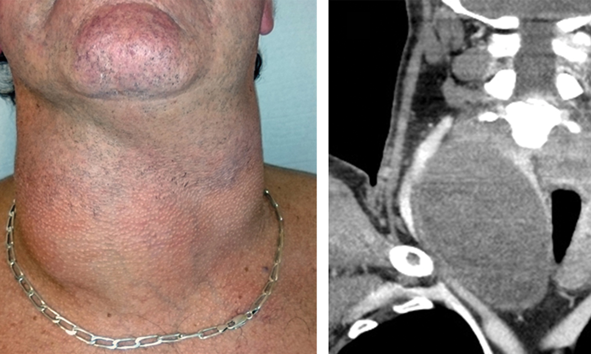 sudden-enlargement-of-the-neck-the-medical-journal-of-australia