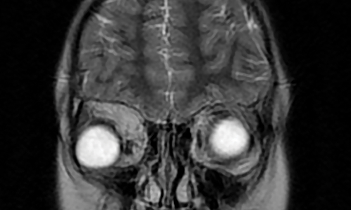 Orbital rhabdomyosarcoma: a rare ophthalmic condition | The Medical