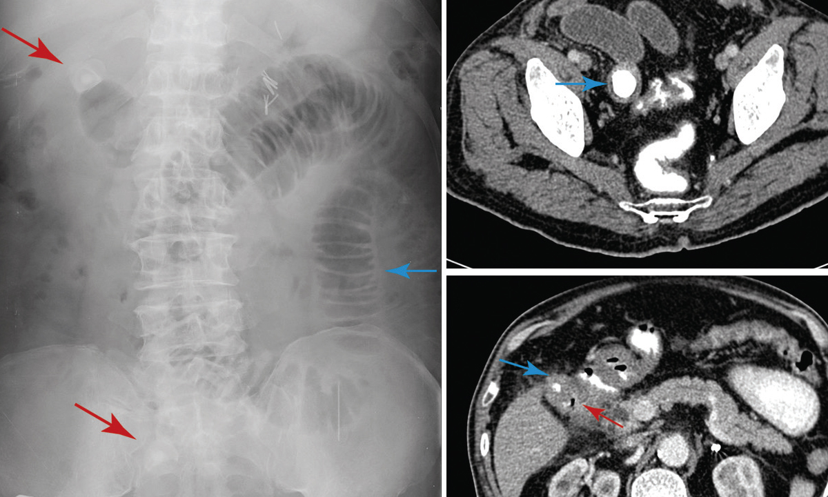 Gallstone ileus | The Medical Journal of Australia