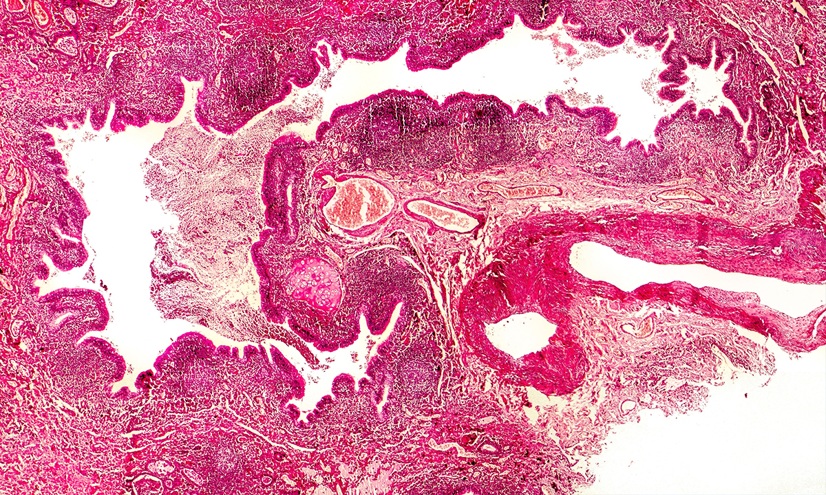 chronic-suppurative-lung-disease-and-bronchiectasis-in-children