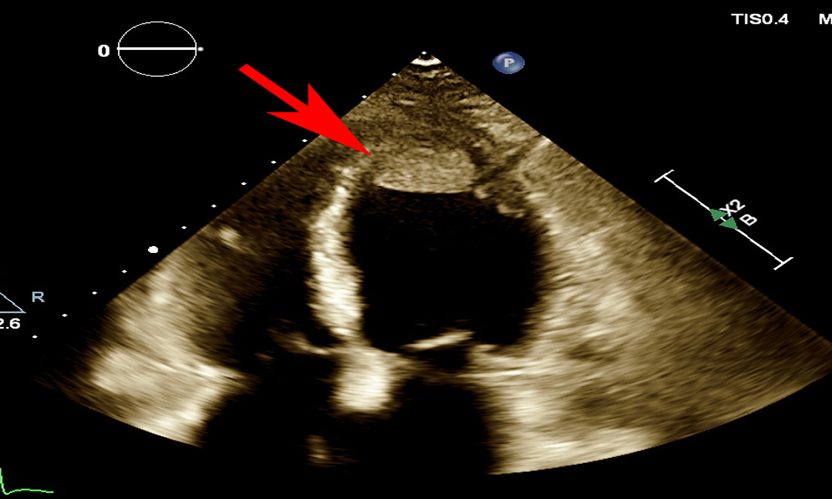 A rare case of peripartum cardiomyopathy complicated by renal and splenic infarctions