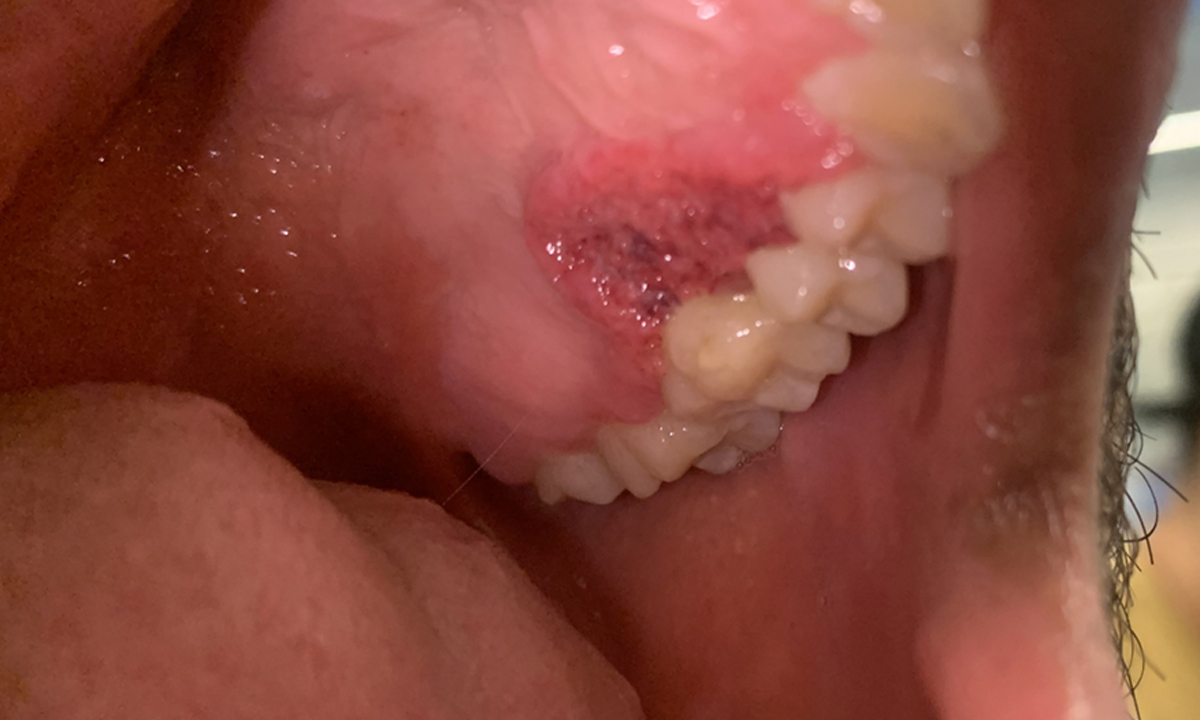 Paracoccidioidomycosis: an Australian case