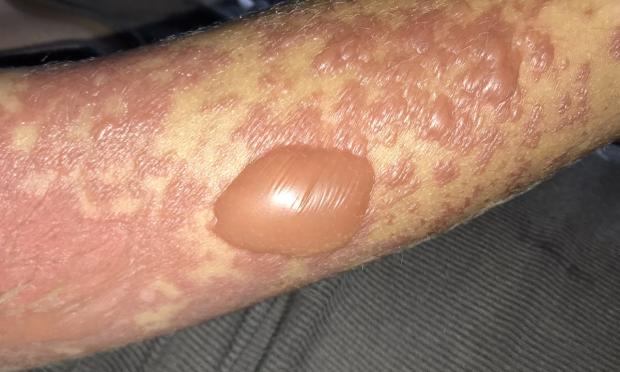 An outbreak of reactive infectious mucocutaneous eruption (RIME) after <fi>Mycoplasma pneumoniae</fi> infections in 