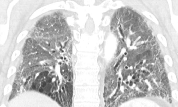 Putting international practice into action: the first case of lung transplantation for COVID‐19 in Victoria, Austr